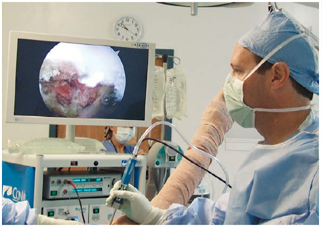 عمل جراحی آرتروسکوپی شانه چیست؟ 