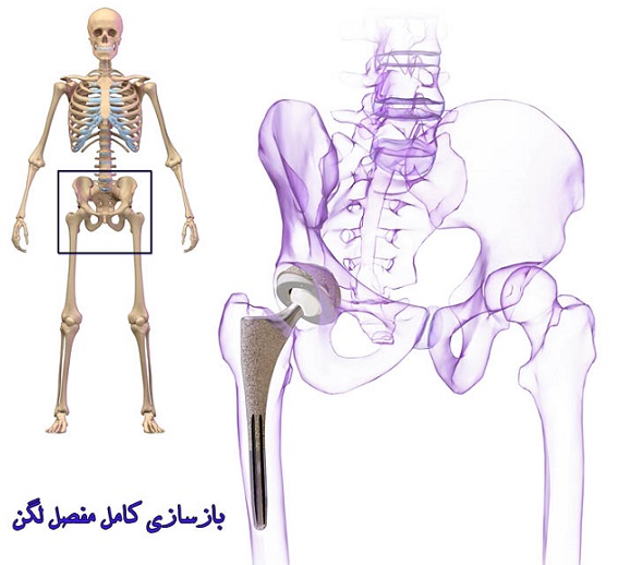 علائم  شکستگی های اطراف مفصل ران