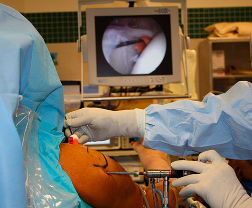 عمل جراحی آرتروسکوپی شانه چیست؟ 