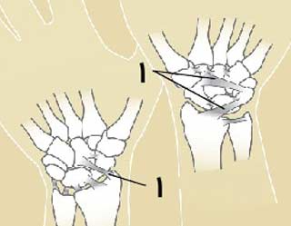 آسیب لیگامان های مچ دست چگونه ایجاد میشود