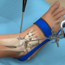 ankle-arthroscopy