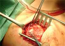 جراحی باز روتاتور کاف در شانه