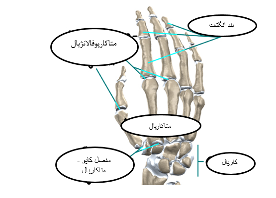 شکستگی گردن استخوان کف دست یا متاکارپ