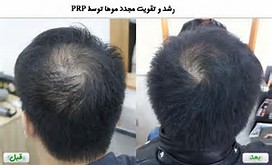 پی آرپی درمان ریزش مو