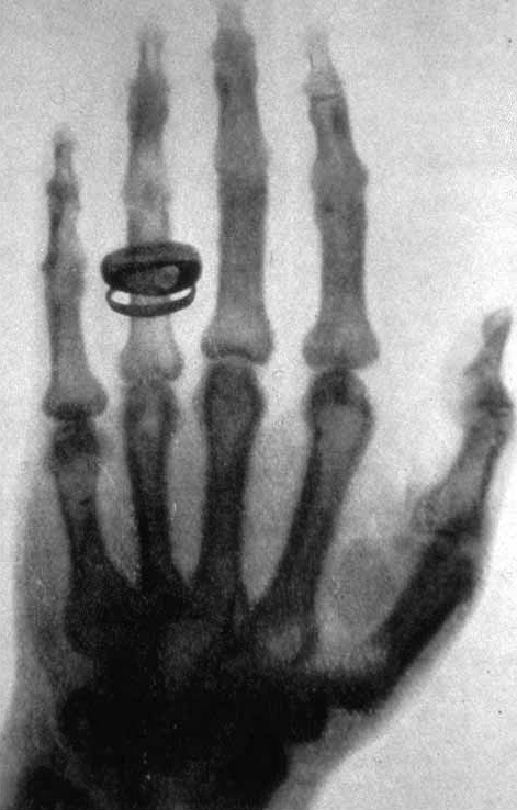 اولین تصویر ایکس ( رادیولوژی ) توسط ویلیام رونتگن 1895 