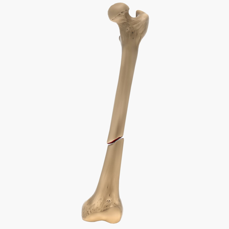 شکستگی مایل (Oblique fracture)