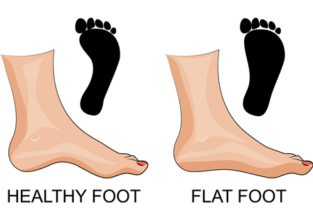 7 تمرین ارتوپدی برای افزایش قوس کف پا و کاهش درد پا