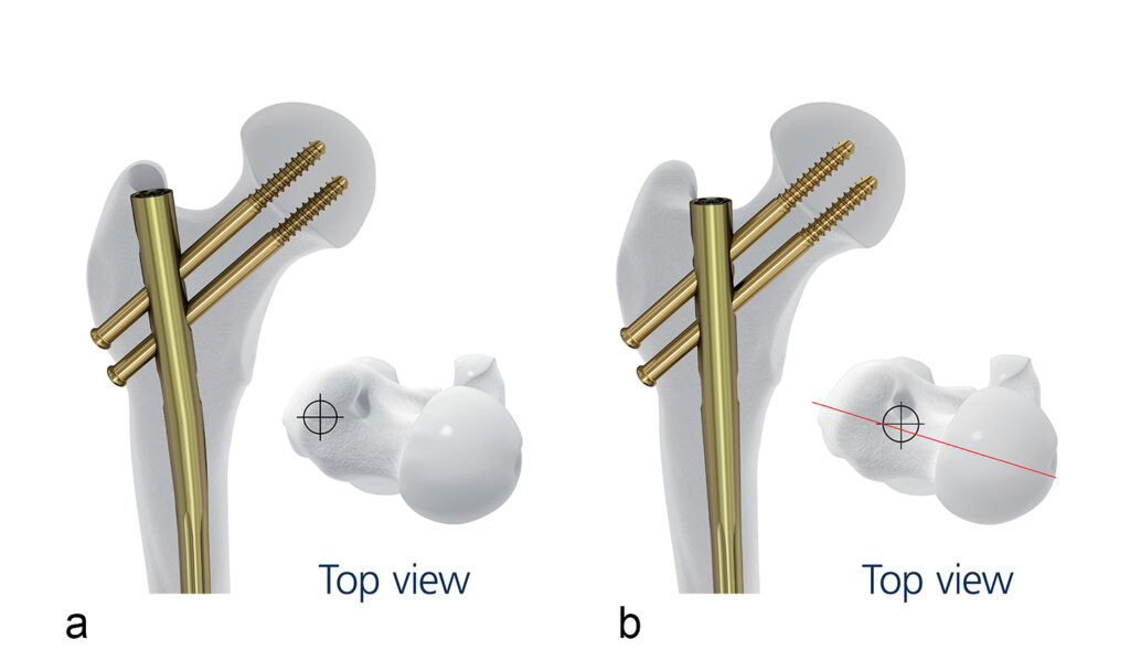 Femoral Recon Nail System