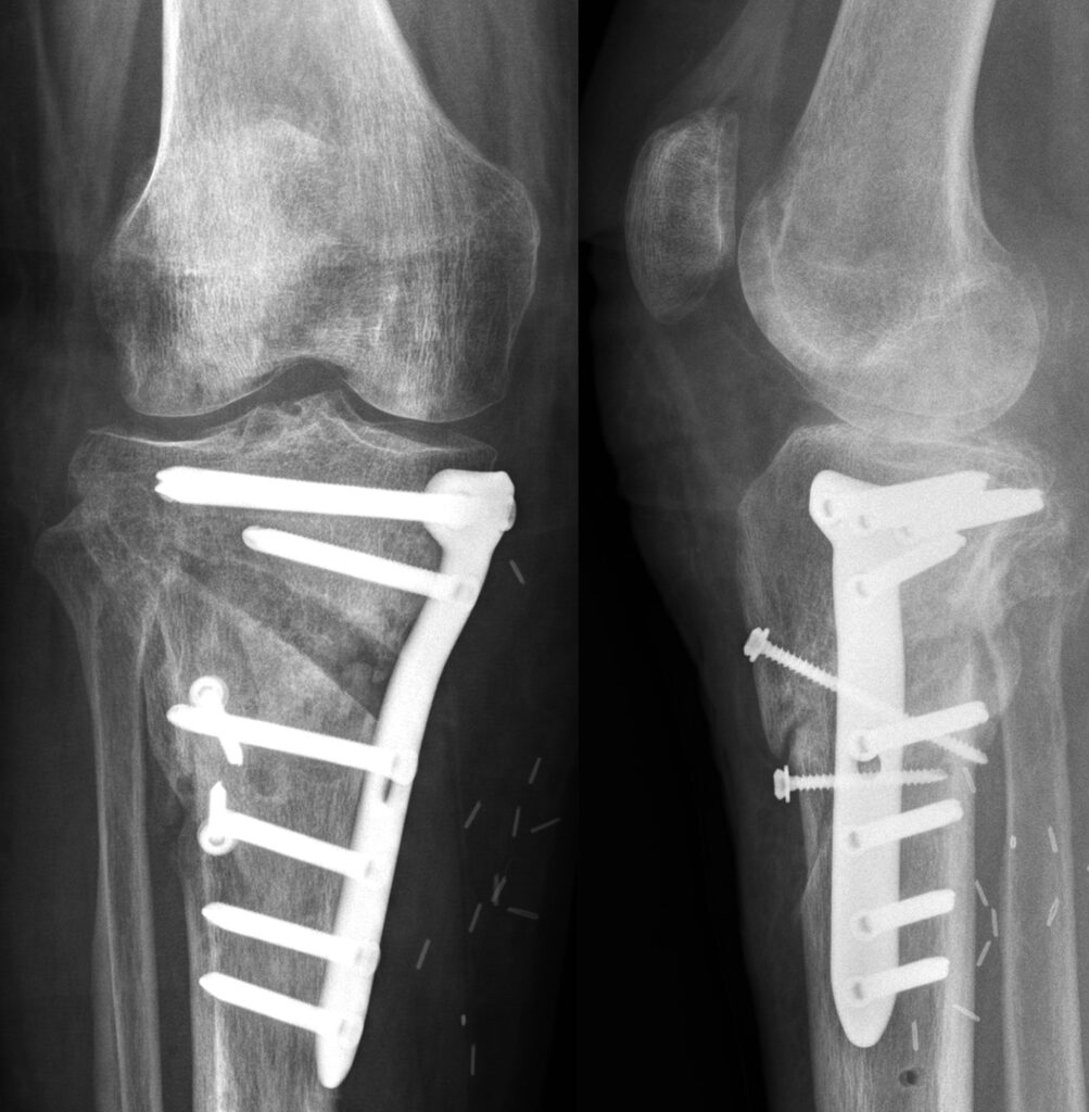 Medial High Tibial Plate (TomoFix Anatomical)