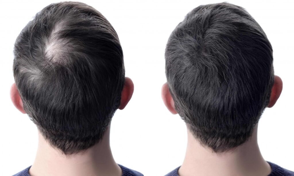 تكلفة زراعة الشعر في ايران