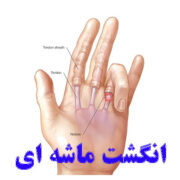 Trigger finger
