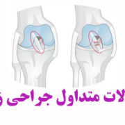 سوالات متداول عمل جراحی ACL